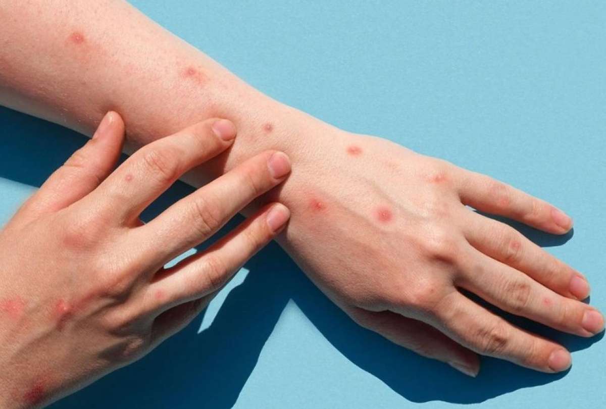 Ministerio de Salud emiti&oacute; recomendaciones para evitar contagios de viruela del mono