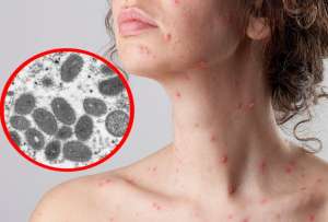 La mayor&iacute;a de los casos se registran en la provincia del Guayas.