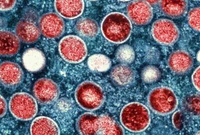 Viruelas del mono: S&iacute;ntomas y c&oacute;mo se transmite esta enfermedad