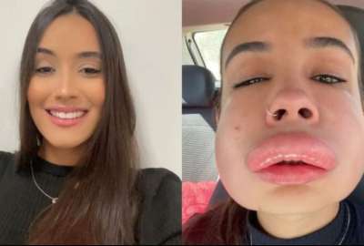 La influencer brasile&ntilde;a Isis de Olivera Almeida Pinheiro sufri&oacute; una reacci&oacute;n al&eacute;rgica a un procedimiento est&eacute;tico.